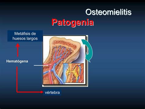 Osteomielitis Y Artritis Septica Ppt