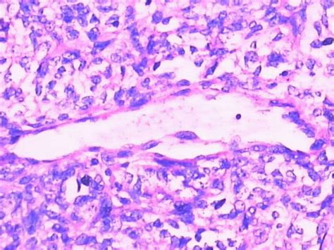 Thirty Nine Cases Of Intracranial Hemangiopericytoma And Anaplastic