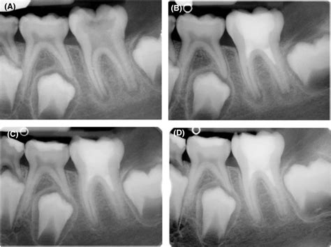 Treatment Of First Left Mandibular Molar A Preoperative Radiograph