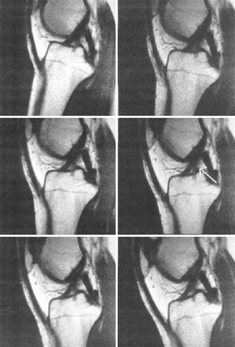 All Knees In This Study Made Contact With The Intercondylar Roof