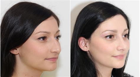 Nose Surgery (Rhinoplasty) | Dr Michael Miroshnik