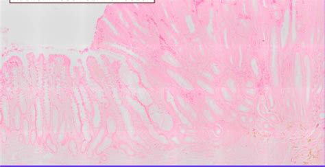 Neoplasia Genpath Lab Doc Padi Flashcards Quizlet