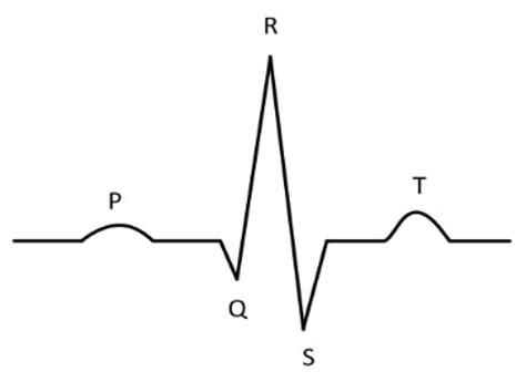 Sensors Free Full Text Atrial Fibrillation Detection With Single Lead Electrocardiogram