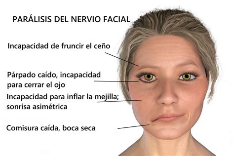 Tipos de parálisis facial síntomas y opciones de tratamiento para