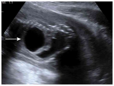 Bladder Exstrophy Ultrasound