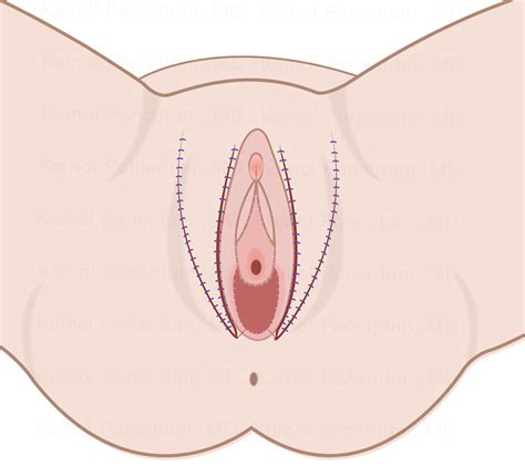 Sensation At The Neo Vagina In Transwoman Kamol Cosmetic Hospital