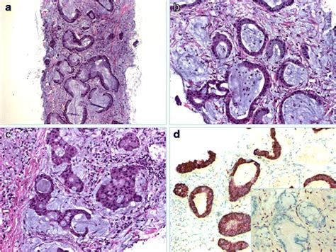 This Case Showed Highly Differentiated Mucinous Epithelial Cells