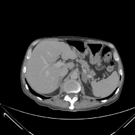 Abdominal Computed Tomography Showing A Normal Image Of The Pancreas Download Scientific Diagram