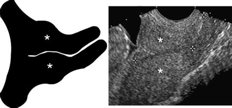 Ultrasound Evaluation Of The Gravid Cervix Radiology Key