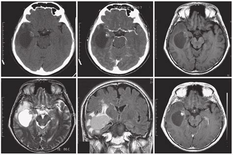 Case 1 Brain Ct And Mr Revealed A Well Circumscribed Cystic Lesion