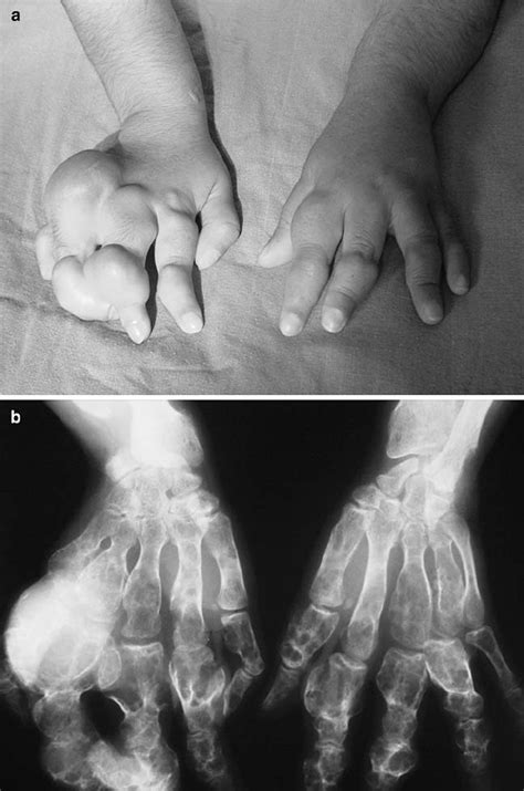 A Dorsal Aspect Of The Hands Showing Multiple Nodules Of The Dorsum Of Download Scientific