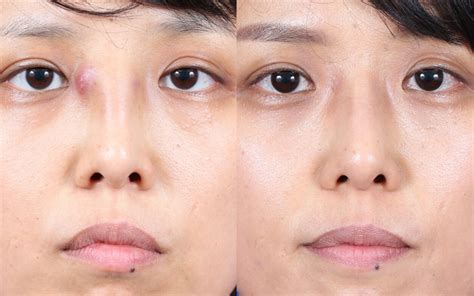 Revision Rhinoplasty Facial Plastic Surgeon