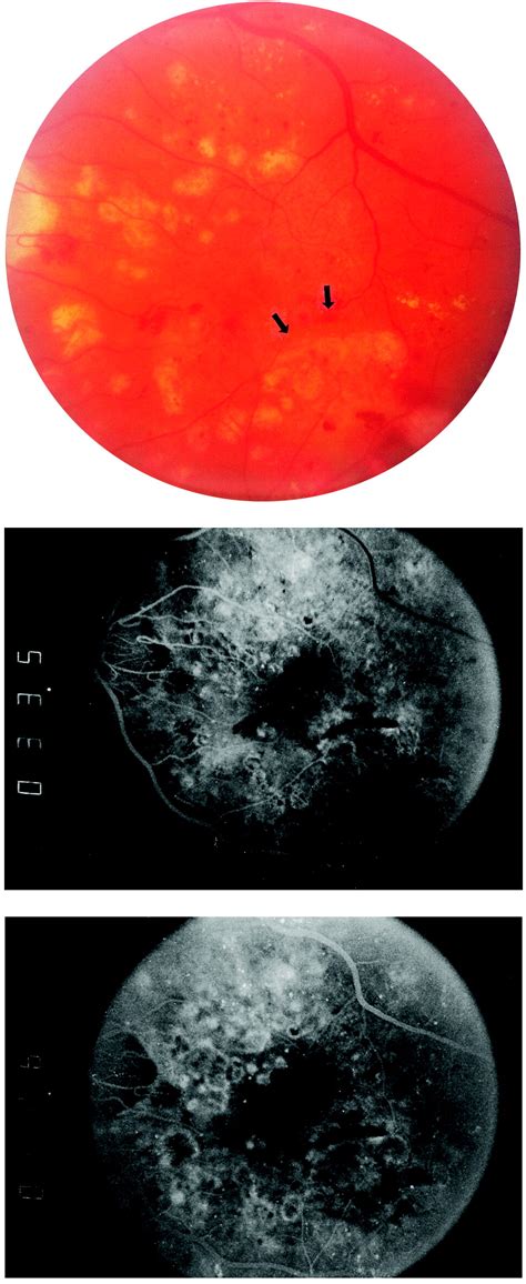 Photodynamic Therapy For Choroidal Neovascularization After Thermal Laser Photocoagulation For