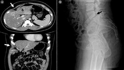 Figure 1 From 18p Deletion Syndrome Originating From Rare Unbalanced Whole Arm Translocation