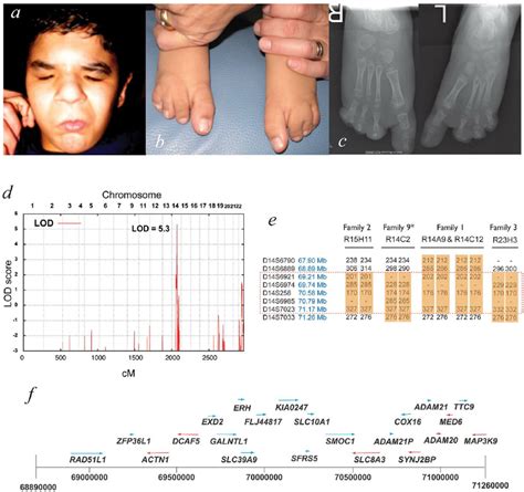 Mapping Ophthalmo Acromelic Syndrome Clinical Photographs A B And