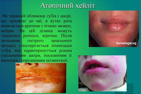 Хейліти. Самостійні хейліти. Симптоматичні хейліти, сучасний погляд ...