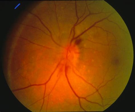 Optic Nerve Anterior Uveitis Flashcards Quizlet