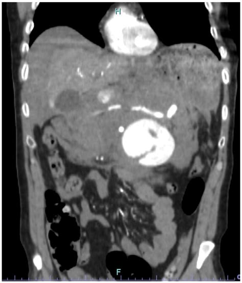 Jcm Free Full Text Endovascular And Open Surgical Treatment Of Ruptured Splenic Artery