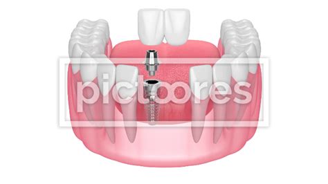 Jaw with implant supported dental cantilever bridge