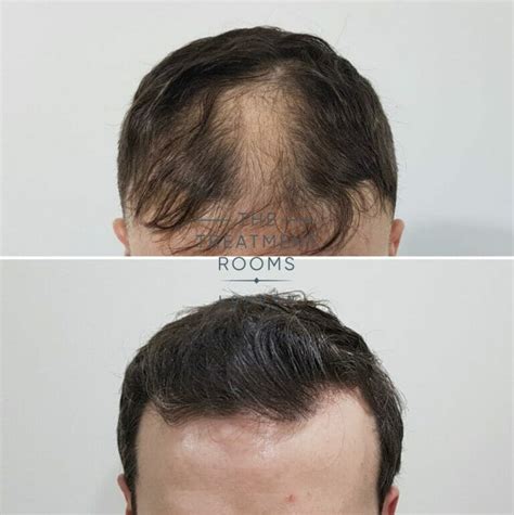 How Many Hair Grafts Do I Need For My Fue Hair Transplant