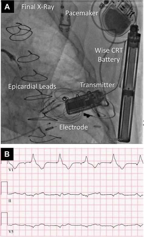 First In Human Wireless Left Ventricular Endocardial Pacing In A