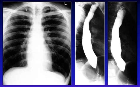 Achalasia - radRounds Radiology Network