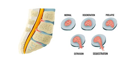 Herniated Disc CAN Heal