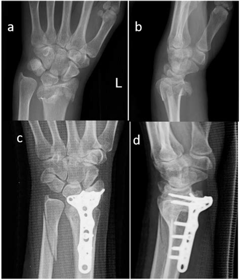 Ulna Fracture X Ray