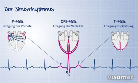 Herzrhythmusstörungen Erkennung Ursachen und Behandlung visomat