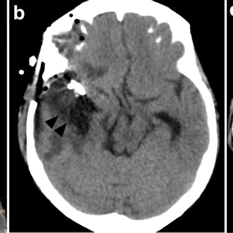 The Preoperative Brain Computed Tomography CT Angiography A