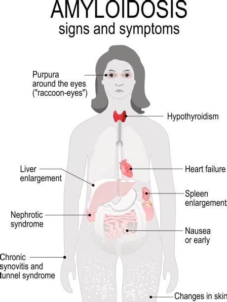 Amyloidosis Symptoms Causes Treatment More Health 24