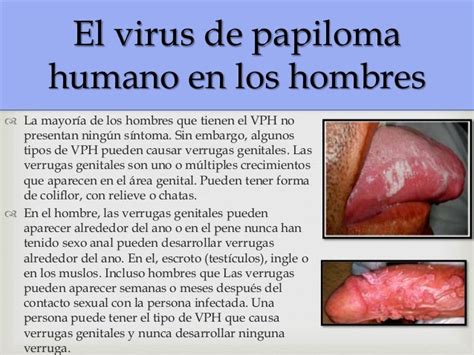 Verrugas Genitales En Hombres Vph En Hombres Causas Sintomas Y Images