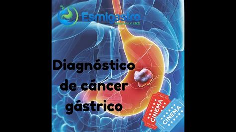 Diagnóstico del Cáncer Gástrico YouTube