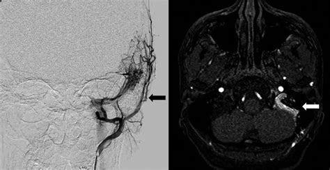 Objective Pulsatile Tinnitus Yacovino 2015 Clinical Case Reports Wiley Online Library