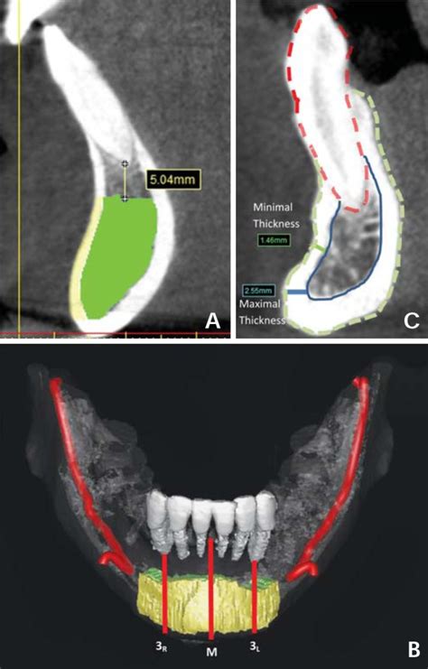 A Cortical Bone Yellow And Cancellous Bone Green Are Defined On