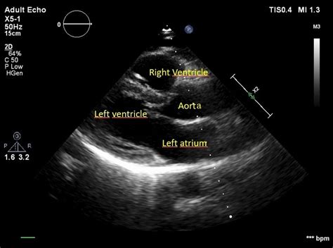 Right Ventricular Strain