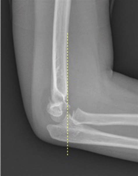 Anterior Humeral Line Ahl Yellow Dotted Line Passing In Front Of The