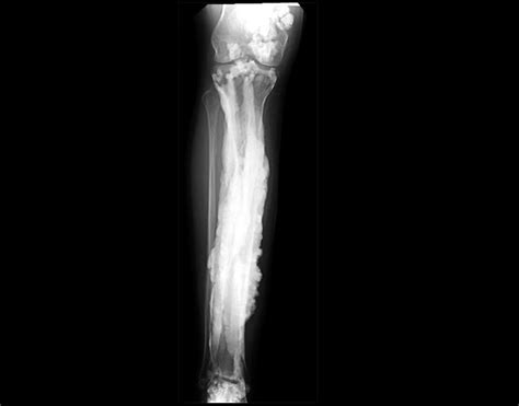 Discovery About Rare Bone Disease May Also Hold Clues About Bone Health