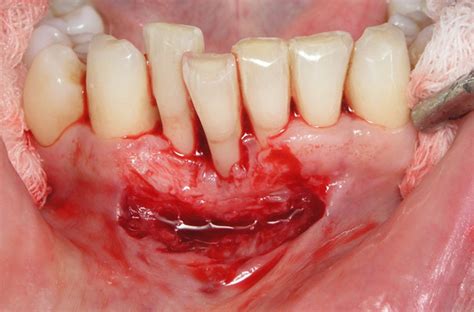 Perda óssea e gengival provocada pela doença periodontal