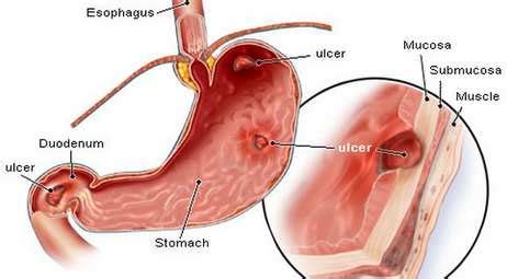 Bleeding Ulcer - Symptoms, Treatment, Diet, Causes, Signs