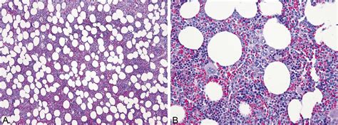 Low Grade B Cell Lymphoma Arising In A Background Of Multifocal Extra