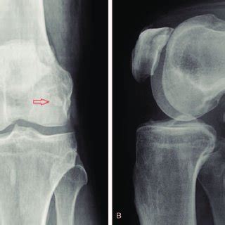 Measurements of the fabella on a sagittal section of the MRI film from ...