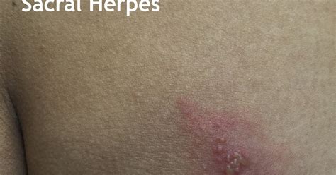 Sacral Herpes: Genital Herpes (HSV-2) Presenting on the Buttock: By