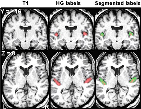 Relating Structure To Function Heschls Gyrus And Acoustic Processing