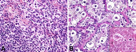 Mixed Germ Cell Sex Cord Stromal Tumour Of The Testis And Ovary Comparison And Contrast Pathology