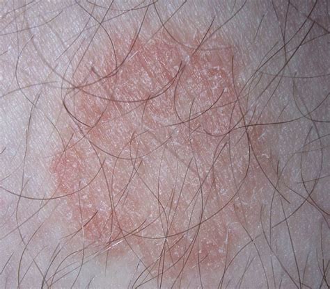 Ringworm In Children Pediatric Center