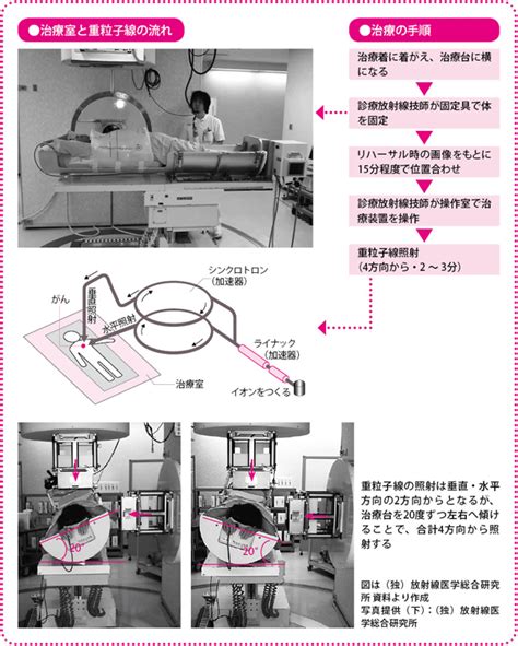 肺がんの「重粒子線治療」治療の進め方は？治療後の経過は？ がんプラス