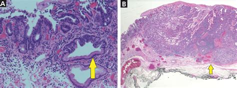 Esophageal Adenocarcinoma A Dire Need For Early Detection And