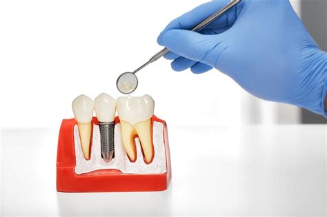 Sabes cómo cuidar tus implantes dentales I Clínica Dental Gramadent