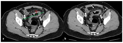 Diagnostics Free Full Text Acute Colonic Diverticulitis Ct